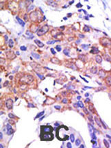 Formalin-fixed and paraffin-embedded human cancer tissue reacted with the primary antibody, which was peroxidase-conjugated to the secondary antibody, followed by AEC staining. This data demonstrates the use of this antibody for immunohistochemistry; clinical relevance has not been evaluated. BC = breast carcinoma; HC = hepatocarcinoma.